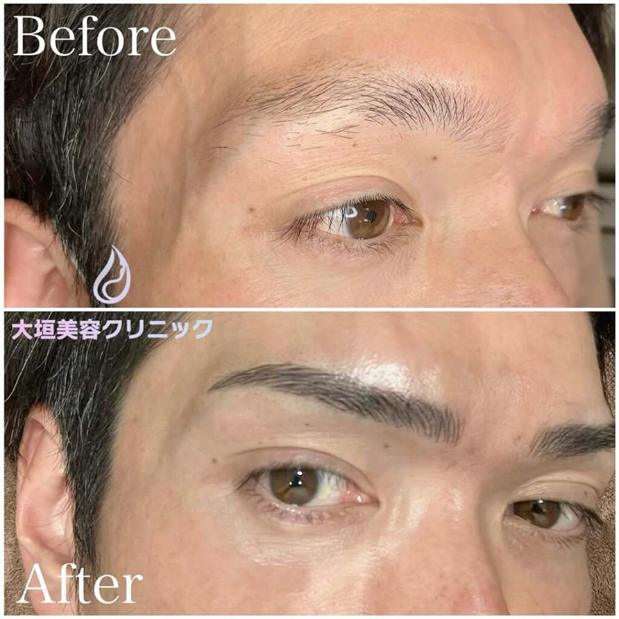 医療アートメイク（眉毛）