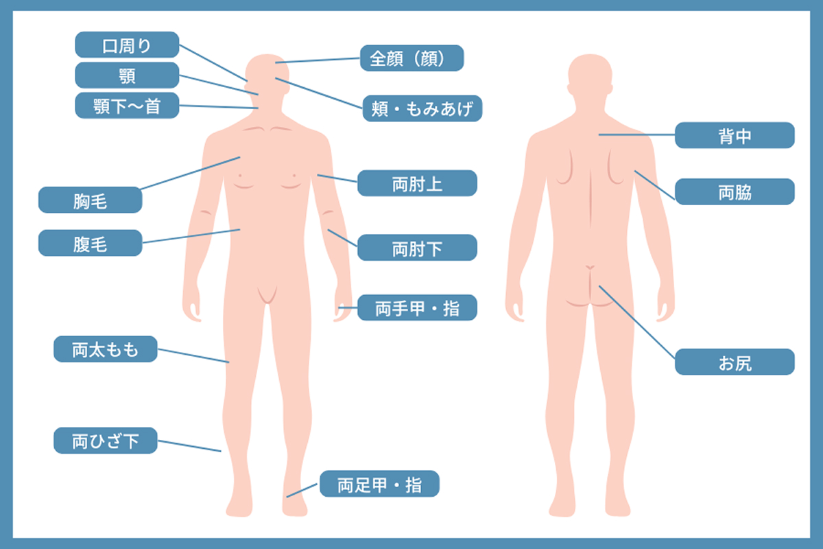 医療脱毛（男性）部位