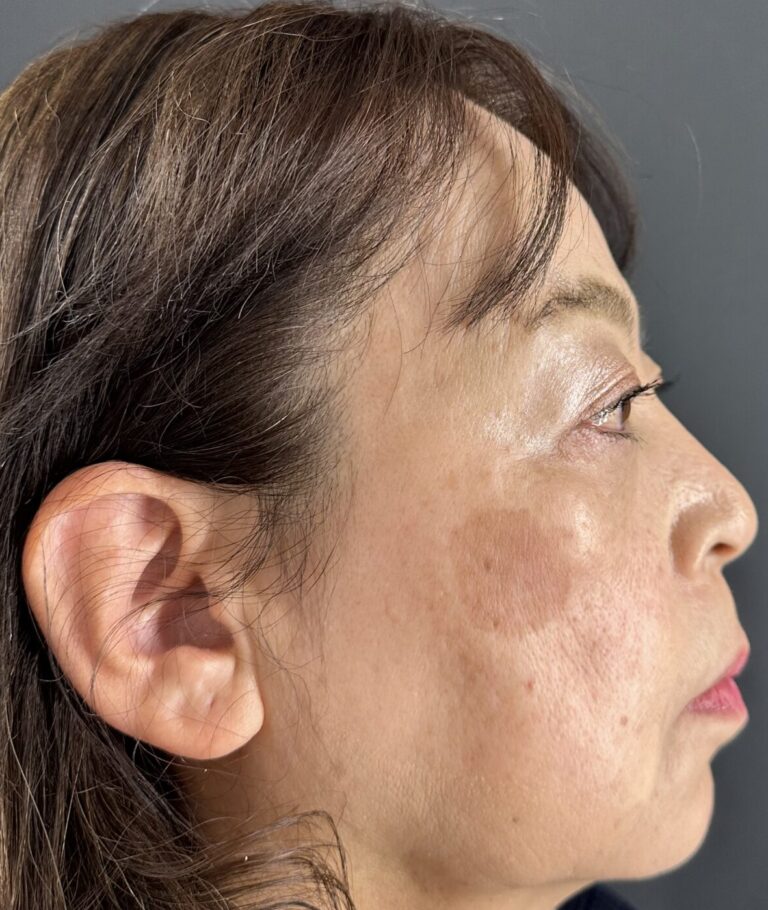シミが気になる患者さんのピコスポット症例と経過｜岐阜・大垣市の美容皮膚科・脱毛の大垣美容クリニック