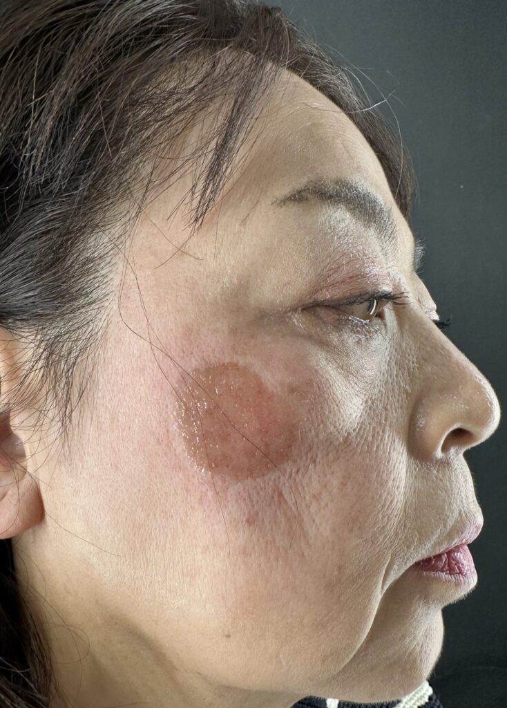シミが気になる患者さんのピコスポット症例と経過｜岐阜・大垣市の美容皮膚科・脱毛の大垣美容クリニック