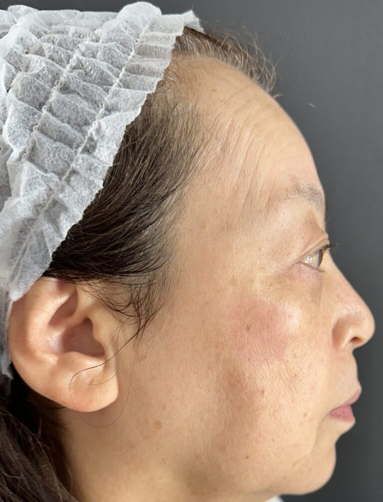 シミが気になる患者さんのピコスポット症例と経過｜岐阜・大垣市の美容皮膚科・脱毛の大垣美容クリニック