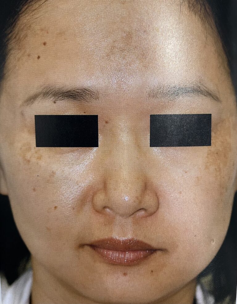 シミの種類について｜岐阜・大垣市の美容皮膚科・脱毛の大垣美容クリニック