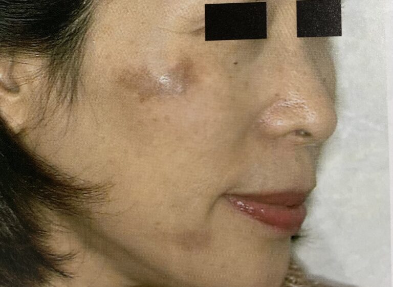 シミの種類について｜岐阜・大垣市の美容皮膚科・脱毛の大垣美容クリニック