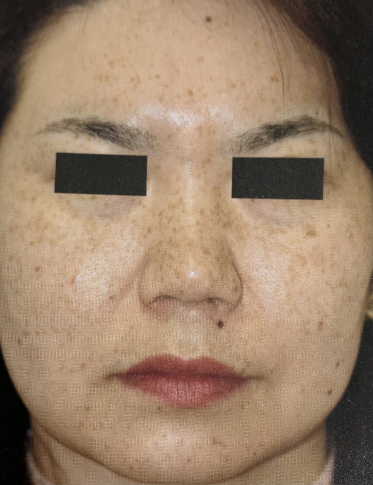 シミの種類について｜岐阜・大垣市の美容皮膚科・脱毛の大垣美容クリニック