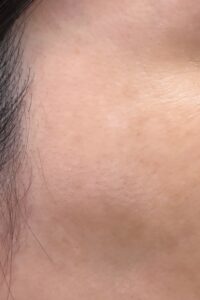 シミ取りしたその後の肌変化｜岐阜・大垣市の美容皮膚科・脱毛の大垣美容クリニック