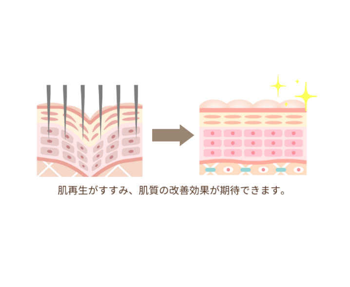ダーマペン4