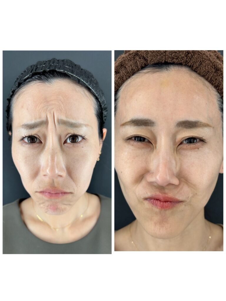 ボトックスとは？効果や仕組みの解説｜岐阜・大垣市の美容皮膚科・脱毛の大垣美容クリニック