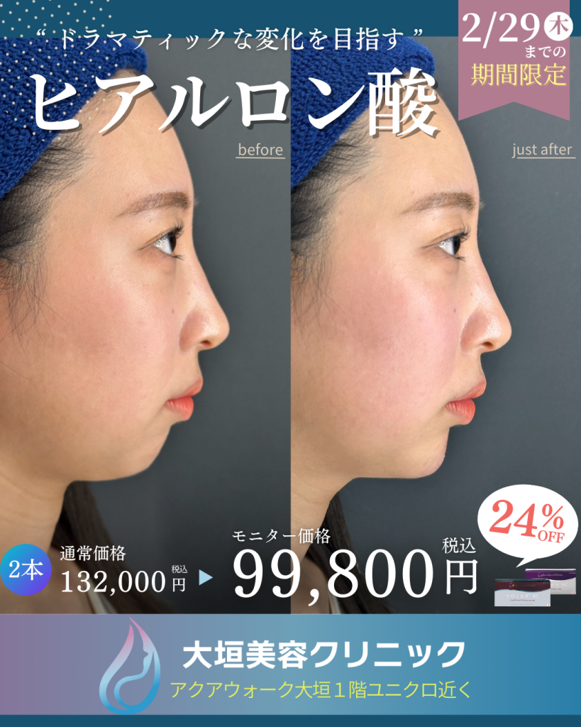 ヒアルロン酸注入は楽しく、奥が深い‼️