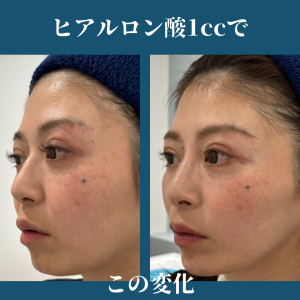 ヒアルロン酸でEライン形成｜岐阜・大垣市の美容皮膚科・脱毛の大垣美容クリニック