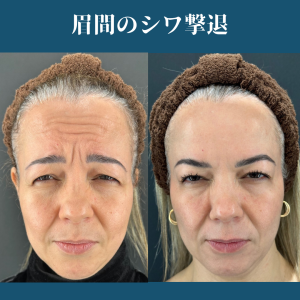シワにはボトックスかヒアルロン酸どっちがいい？｜岐阜・大垣市の美容皮膚科・脱毛の大垣美容クリニック