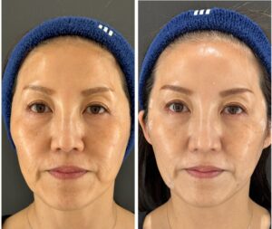 糸リフト（アルテミス）の効果｜岐阜・大垣市の美容皮膚科・脱毛の大垣美容クリニック