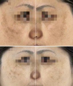美容内服のビフォーアフター|岐阜・大垣市の美容皮膚科・脱毛の大垣美容クリニック