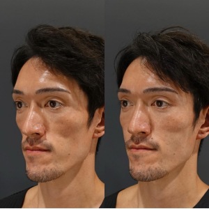 ヒアルロン酸で頬コケ改善！水川先生大変身｜岐阜・大垣市の美容皮膚科・脱毛の大垣美容クリニック
