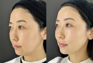 糸リフト1ヶ月後のビフォーアフター｜痛み・ダウンタイムの感想｜岐阜・大垣市の美容皮膚科・脱毛の大垣美容クリニック