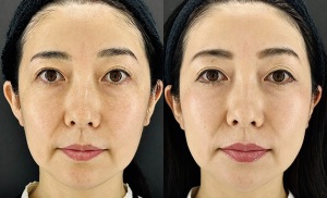 糸リフト1ヶ月後のビフォーアフター｜痛み・ダウンタイムの感想｜岐阜・大垣市の美容皮膚科・脱毛の大垣美容クリニック