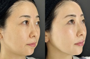 糸リフト1ヶ月後のビフォーアフター｜痛み・ダウンタイムの感想｜岐阜・大垣市の美容皮膚科・脱毛の大垣美容クリニック