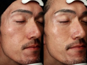 「メソナSA」肌の透明感とハリを叶えるスペシャルケア｜岐阜・大垣市の美容皮膚科・脱毛の大垣美容クリニック