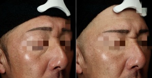 肌をふっくら――ベビーコラーゲンで小じわ・たるみ改善｜岐阜・大垣市の美容皮膚科・脱毛の大垣美容クリニック