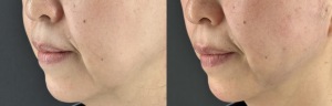 糸リフトによるたるみ改善｜岐阜での症例ビフォーアフター｜岐阜・大垣市の美容皮膚科・脱毛の大垣美容クリニック