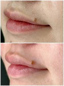 薄い唇が気になる方へ｜唇ヒアルロン酸で叶う自然な変化とは？｜岐阜・大垣市の美容皮膚科・脱毛の大垣美容クリニック