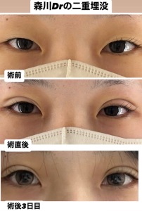 二重埋没の症例紹介｜自然で可愛い仕上がりと術後経過｜岐阜・大垣市の美容皮膚科・脱毛の大垣美容クリニック