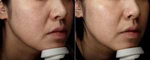 プルリアルデンシファイとは?リジュランとの違いを解説|岐阜・大垣市の美容皮膚科・脱毛の大垣美容クリニック