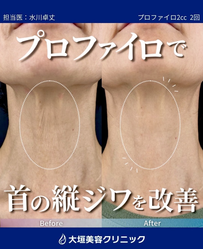 プロファイロ