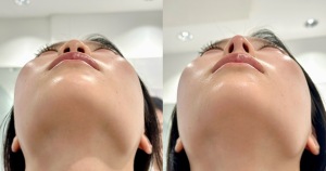 鼻ヒアルロン酸で理想の鼻筋へ|岐阜・大垣市の美容皮膚科・脱毛の大垣美容クリニック