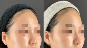鼻ヒアルロン酸で理想の鼻筋へ|岐阜・大垣市の美容皮膚科・脱毛の大垣美容クリニック