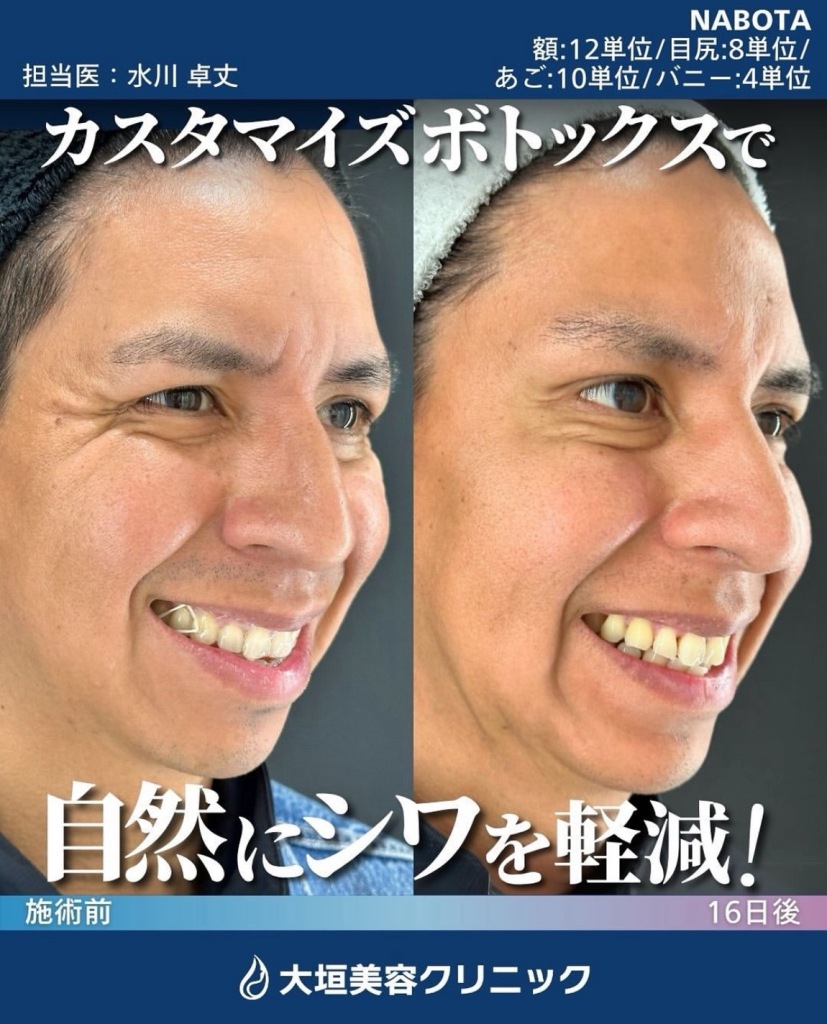 ボトックス