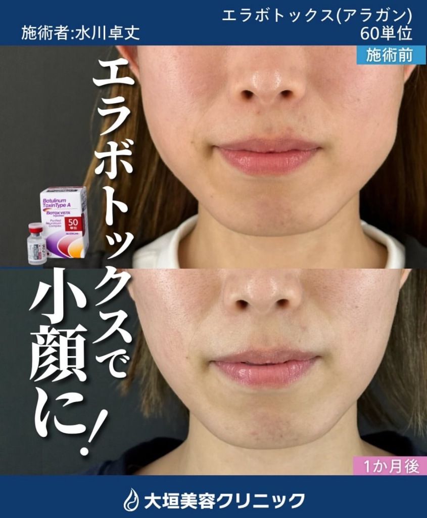 ボトックス（エラ）