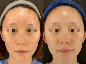 ニキビ治療は美容皮膚科で！アゼライン酸とレーザーフェイシャルの効果とは？｜岐阜・大垣市の美容皮膚科・脱毛の大垣美容クリニック