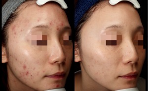 ニキビ治療は美容皮膚科で！アゼライン酸とレーザーフェイシャルの効果とは？｜岐阜・大垣市の美容皮膚科・脱毛の大垣美容クリニック