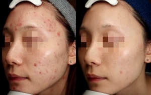 ニキビ治療は美容皮膚科で！アゼライン酸とレーザーフェイシャルの効果とは？｜岐阜・大垣市の美容皮膚科・脱毛の大垣美容クリニック