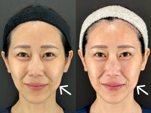 【切らないリフトアップ】ポテンツァ・ダイヤモンドチップの効果とは？小顔とたるみ予防を同時に叶える ｜岐阜・大垣市の美容皮膚科・脱毛の大垣美容クリニック