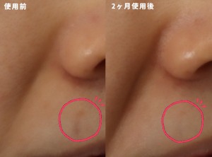スキンブライセラム0.25の効果は?レチノールで叶えるハリ・ツヤ肌|岐阜・大垣市の美容皮膚科・脱毛の大垣美容クリニック