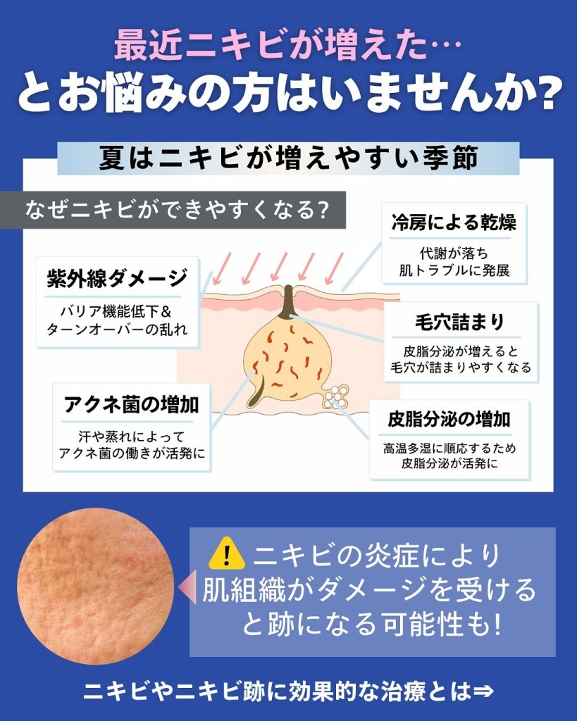 岐阜・大垣美容クリニックの美容皮膚科スタッフが教えるニキビ治療の選び方と治療別メリット｜岐阜・大垣市の美容皮膚科・脱毛の大垣美容クリニック