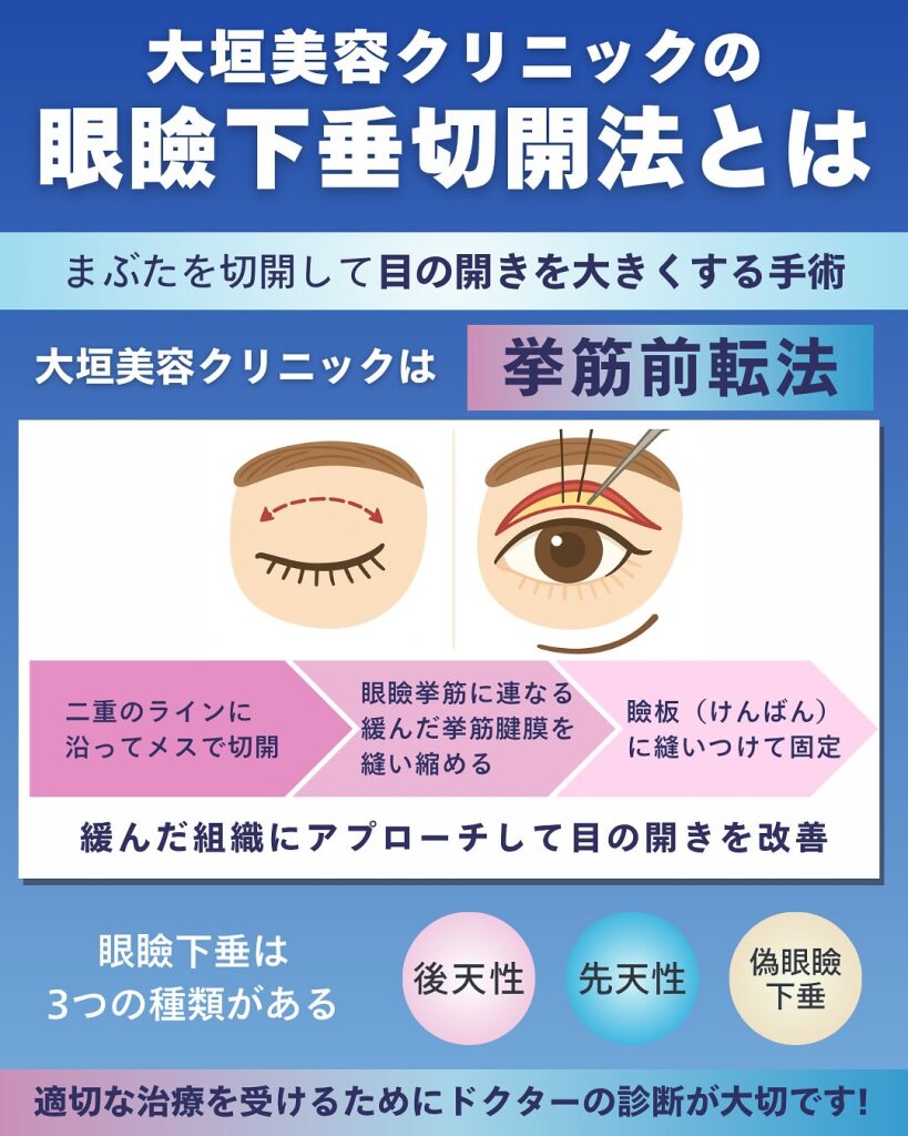 眼瞼下垂切開法