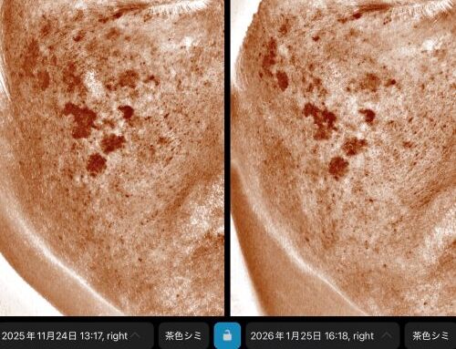 美白内服の効果は？1か月で見られたシミの変化【男性症例】｜岐阜・大垣市の美容皮膚科・脱毛の大垣美容クリニック
