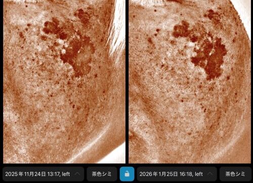 美白内服の効果は？1か月で見られたシミの変化【男性症例】｜岐阜・大垣市の美容皮膚科・脱毛の大垣美容クリニック