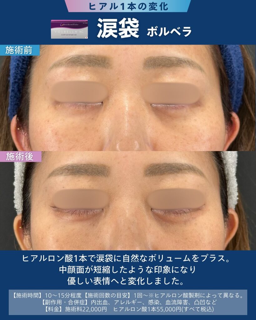 ヒアルロン酸で涙袋形成｜ナチュラルな目元を作るためのポイント｜大垣美容クリニック