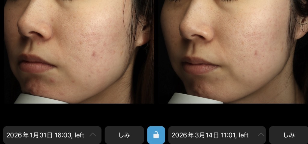 ゼオスキンはニキビにおすすめ?使用した3アイテムと1ヶ月の変化|岐阜・大垣市の美容皮膚科・脱毛の大垣美容クリニック