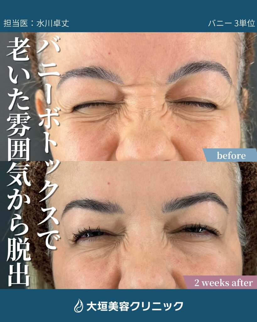バニーラインのボトックスを岐阜で|笑うと出る鼻横のシワ、気になっていませんか?