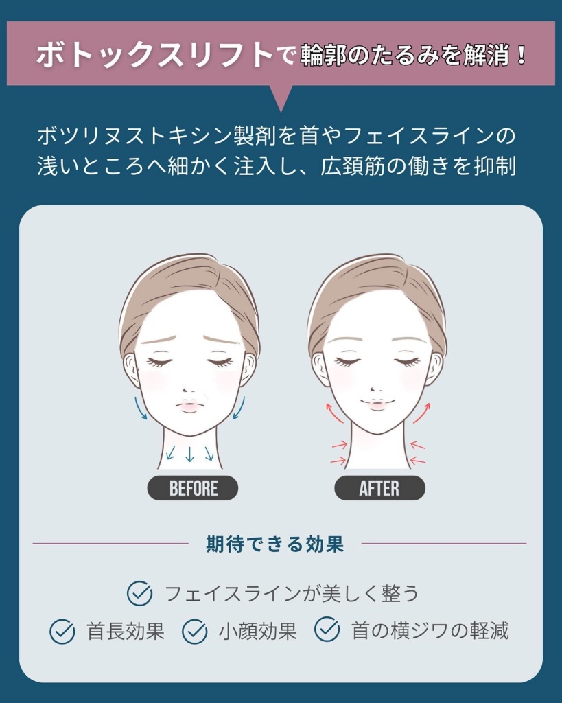 広頚筋ボトックス