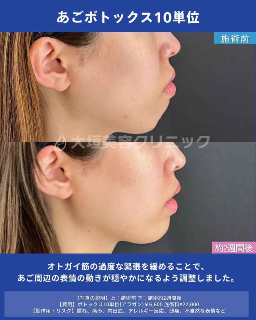 顎ボトックス