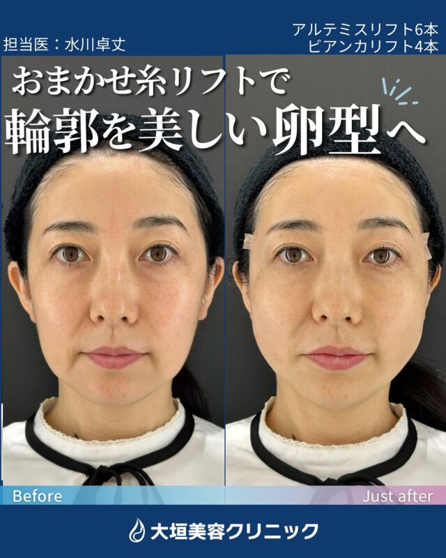 .
#糸リフト とは
特殊なトゲのある溶ける糸を挿入し、
フェイスラインのリフトアップができる治療✨

🔹顔のたるみが気になる
🔹肌にハリや弾力がほしい
🔹切らずに自然なリフトアップを叶えたい
🔹ダウンタイムが短い治療がいい
🔹フェイスラインだけでなく顎下や二重顎が気になる
🔹リフティング効果を維持させたい
などのお悩みの方におすすめです☺

𓐄 𓐄 𓐄 𓐄 𓐄 𓐄 𓐄 𓐄 𓐄 𓐄 𓐄 𓐄 𓐄 𓐄 𓐄 𓐄 𓐄 𓐄 𓐄 𓐄 𓐄 𓐄

💠大垣美容クリニック

📍岐阜県大垣市林町6-80-21アクアウォーク大垣1F
🚃大垣駅より徒歩2分

𓐄 𓐄 𓐄 𓐄 𓐄 𓐄 𓐄 𓐄 𓐄 𓐄 𓐄 𓐄 𓐄 𓐄 𓐄 𓐄 𓐄 𓐄 𓐄 𓐄 𓐄 𓐄

#美容クリニック#岐阜美容皮膚科#美容医療#美容皮膚科#アルテミスリフト#スレッドリフト

.

施術名：糸リフト（アルテミスリフト、BIANCALIFT）
費用：
施術時価：約30分
※麻酔・カウンセリング等は含まれていません。
※施術内容によって個人差があります。
施術回数の目安：1回（仕上がりまでに1ヶ月程度必要）
※効果の持続を希望される場合は、定期的な治療を推奨いたします。
治療後、仕上がりまでには1ヶ月程度かかります。
副作用・リスク：だるさ、熱感、じんましん、頭痛、むくみ、かゆみ、発熱、咳、冷や汗、アナフィラキシーショック、胸痛、呼吸困難、皮膚が凹む、異物感、内出血、痛み、傷跡など