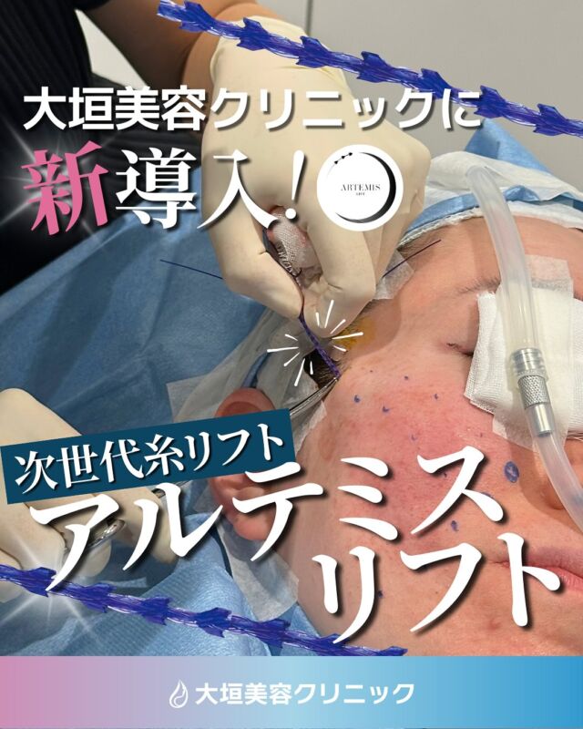 ．
👑NEW！👑
＼アルテミスリフト導入決定／

引き上げ力×固定力×持続力に優れた次世代糸リフト
【アルテミスリフト】が大垣美容クリニックで受けられるようになりました✨

🔷アルテミスリフトとは
日本人の骨格やニーズに合わせたスレッドリフト

💡独立したコグがしっかりと引き上げる
💡特殊なメッシュ構造で持続力が高い
💡先端が丸く、皮下出血や神経損傷のリスクを軽減

✔顔のたるみを引き上げたい
✔小顔になりたい
✔二重顎をなくしたい
✔メスを使わずにリフトアップしたい
このような方にぴったりな施術です◎

ぜひお気軽にご相談ください🤲🏻

 𓐄 𓐄 𓐄 𓐄 𓐄 𓐄 𓐄 𓐄 𓐄 𓐄 𓐄 𓐄 𓐄 𓐄 𓐄 𓐄 𓐄 𓐄 𓐄 𓐄 𓐄

💠大垣美容クリニック

📍岐阜県大垣市林町6-80-21アクアウォーク大垣1F
🚃大垣駅より徒歩2分

𓐄 𓐄 𓐄 𓐄 𓐄 𓐄 𓐄 𓐄 𓐄 𓐄 𓐄 𓐄 𓐄 𓐄 𓐄 𓐄 𓐄 𓐄 𓐄 𓐄 𓐄 𓐄

#大垣ボトックス#岐阜ヒアルロン酸#大垣市 #美容クリニック#岐阜美容皮膚科#名古屋美容クリニック#美容医療#美容皮膚科#大垣美容クリニック#アルテミスリフト#糸リフト#たるみ